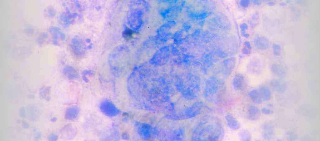 Olho De Herpes Zoster